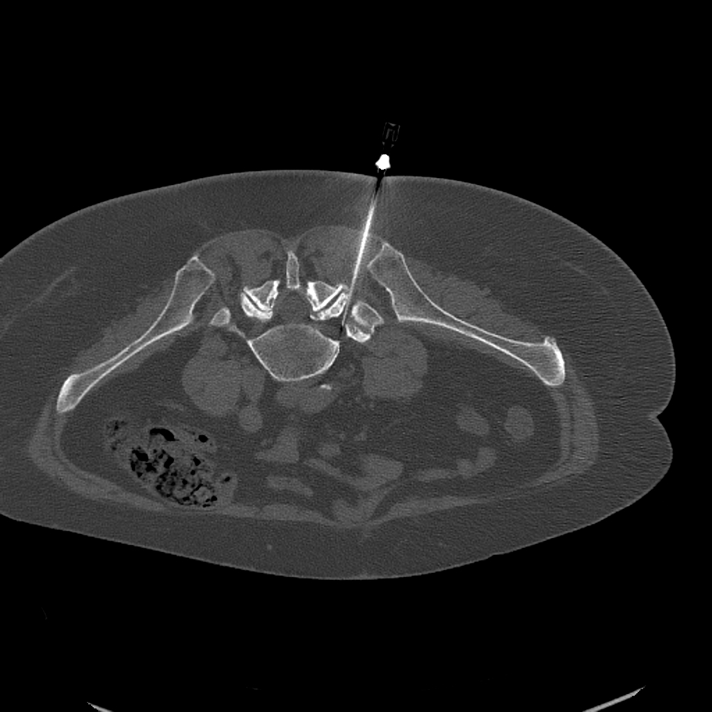 CT-vezérelt ideggyöki blokád — axiális CT-felvétel a tű pozíciójával