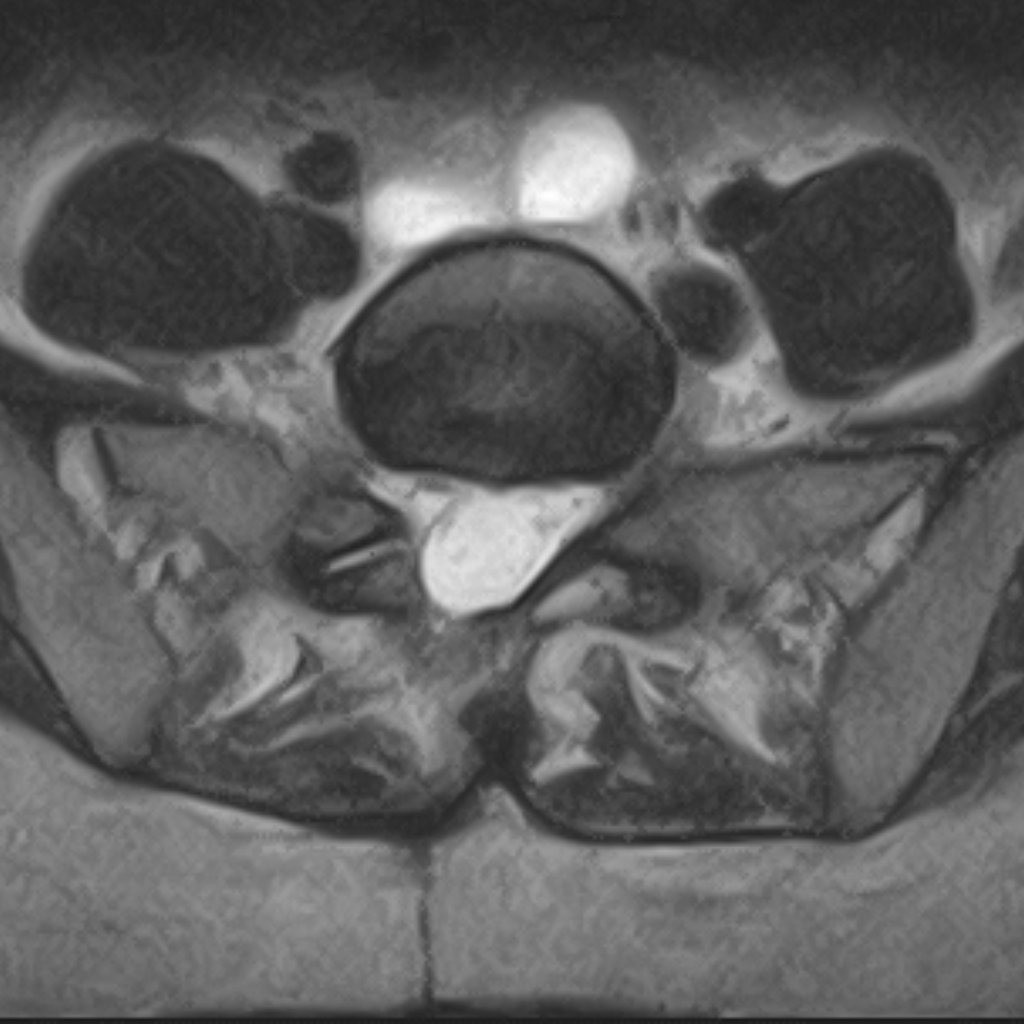 Axiális MRI felvétel — műtét utáni állapot