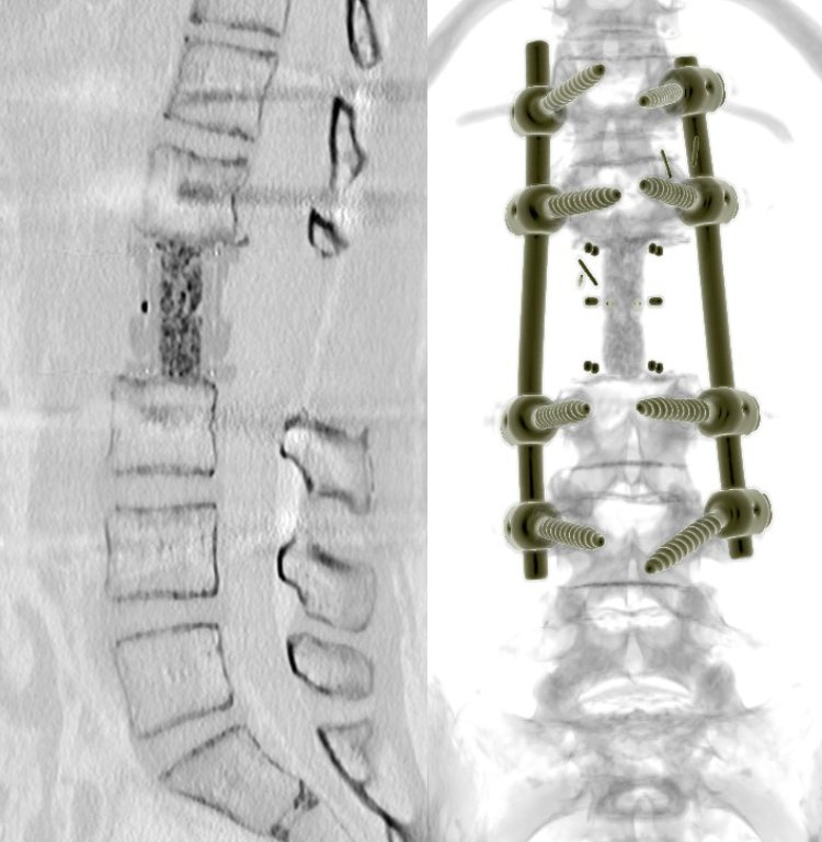 Gerincdaganat en bloc rezekció utáni CT rekonstrukció — sagittális és AP nézet instrumentációval