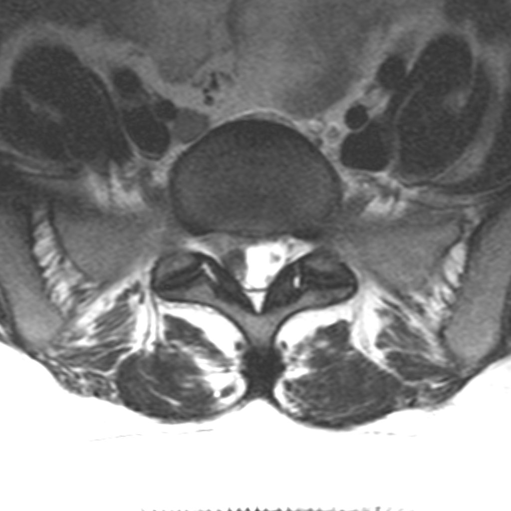 Axiális MRI felvétel — lumbális porckorongsérv